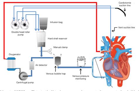 centrifugal pump cardiopulmonary bypass|cardiopulmonary bypass circuit diagram.